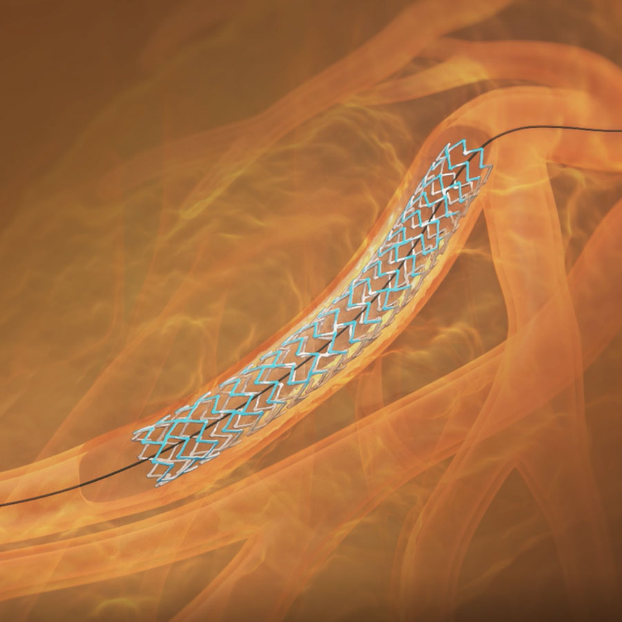 SYNERGY XD Everolimus Eluting Platinum Chromium Coronary Stent System